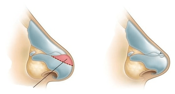 Коррекция формы носа
