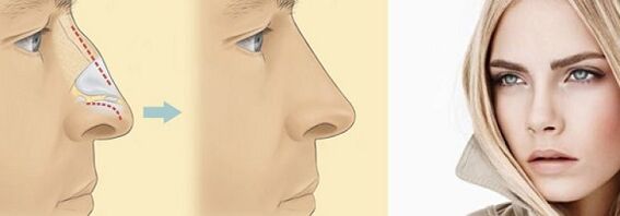 коррекция формы носа безоперационной ринопластикой