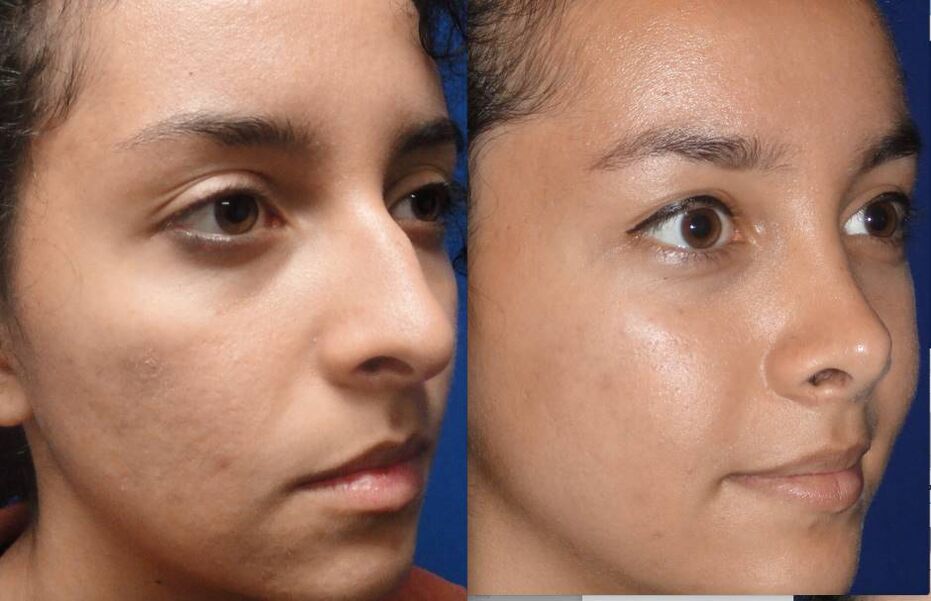 фото до и после закрытой ринопластики носа