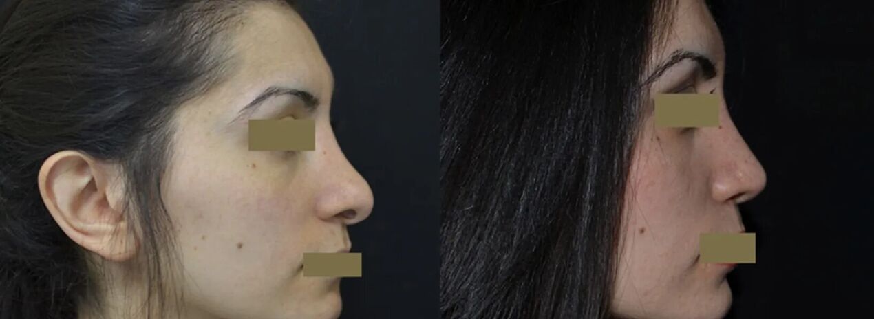до и после ринопластики носа