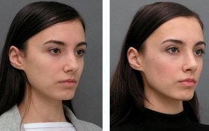 Девушка до и после ринопластики носа